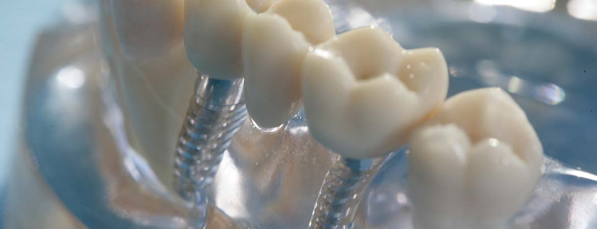 Hochwertige Zahnimplantate Salzkotten: fester Zahnersatz