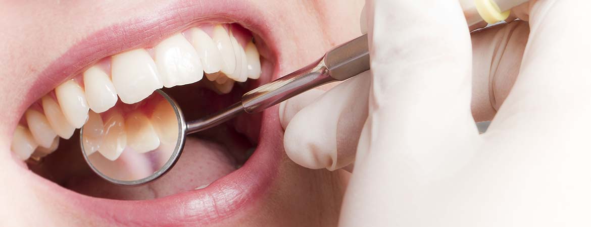 Parodontose beim Zahnarzt in Salzkotten behandeln lassen